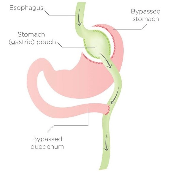 Graphic of stomach after Gastric Bypass Surgery
