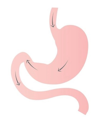 Graphic of stomach before Gastric Bypass Surgery