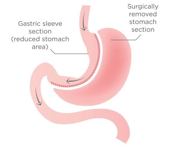 Graphic of stomach after Sleeve Gastrectomy Weight Loss Surgery