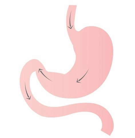 Graphic of stomach before Sleeve Gastrectomy Weight Loss Surgery