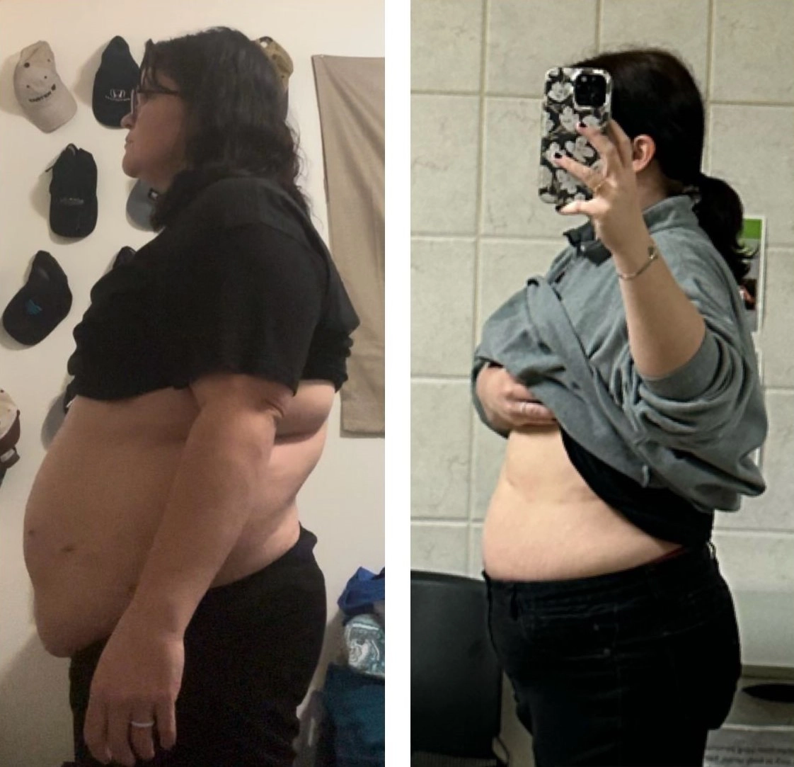 Stephanie Marie Haaz before and after Lap-Band surgery Stephanie Marie Haaz before and after Lap-Band surgery