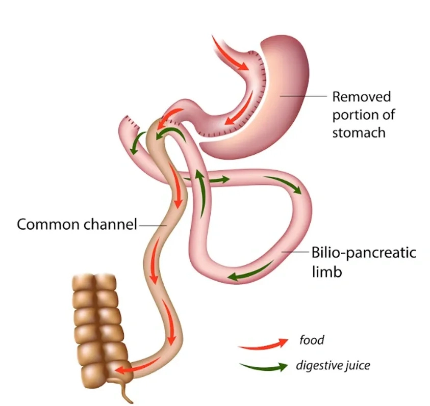 Graphic of Stomach After SADI-S Procedure